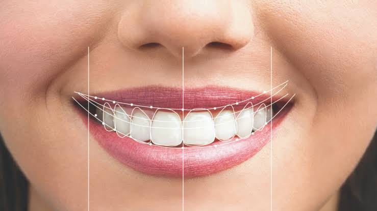Smile Designing